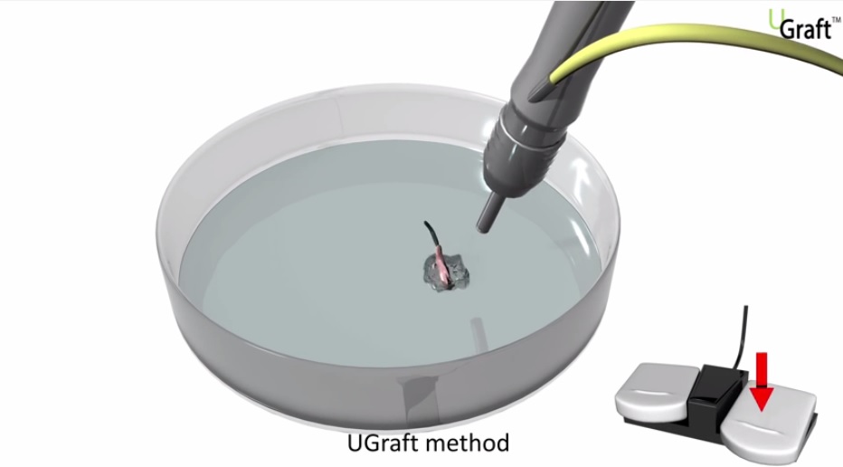 UGraft System foot pedal fluid -graft flush mechanism