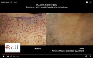 Chest hair extraction wound healing by Dr U