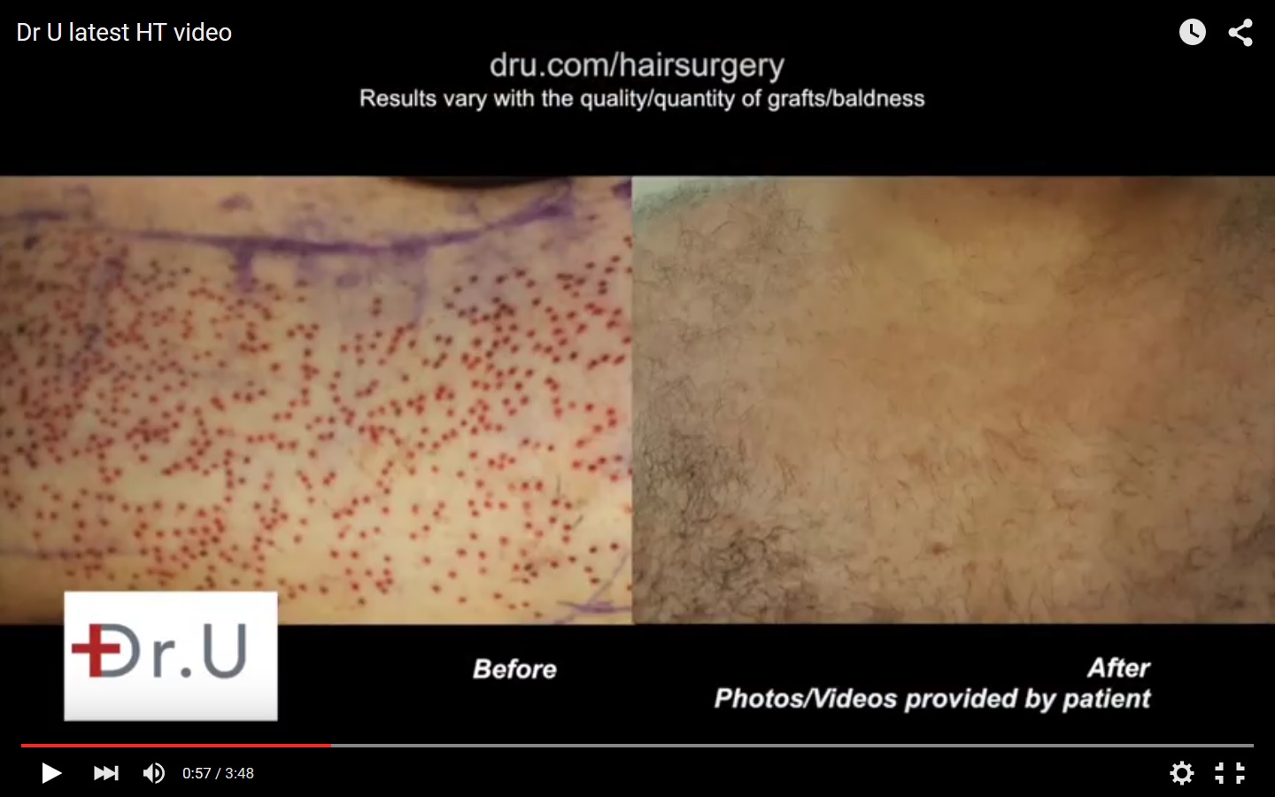 Wound healing after hair restoration. Chest hair extraction wound healing by Dr U