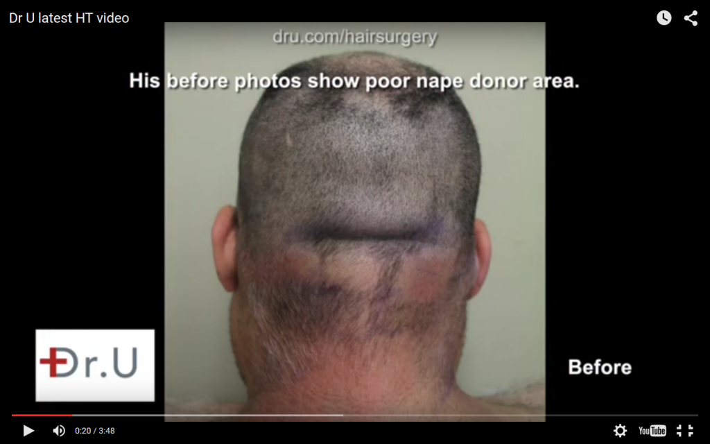 FUE Shave Test poor candidate