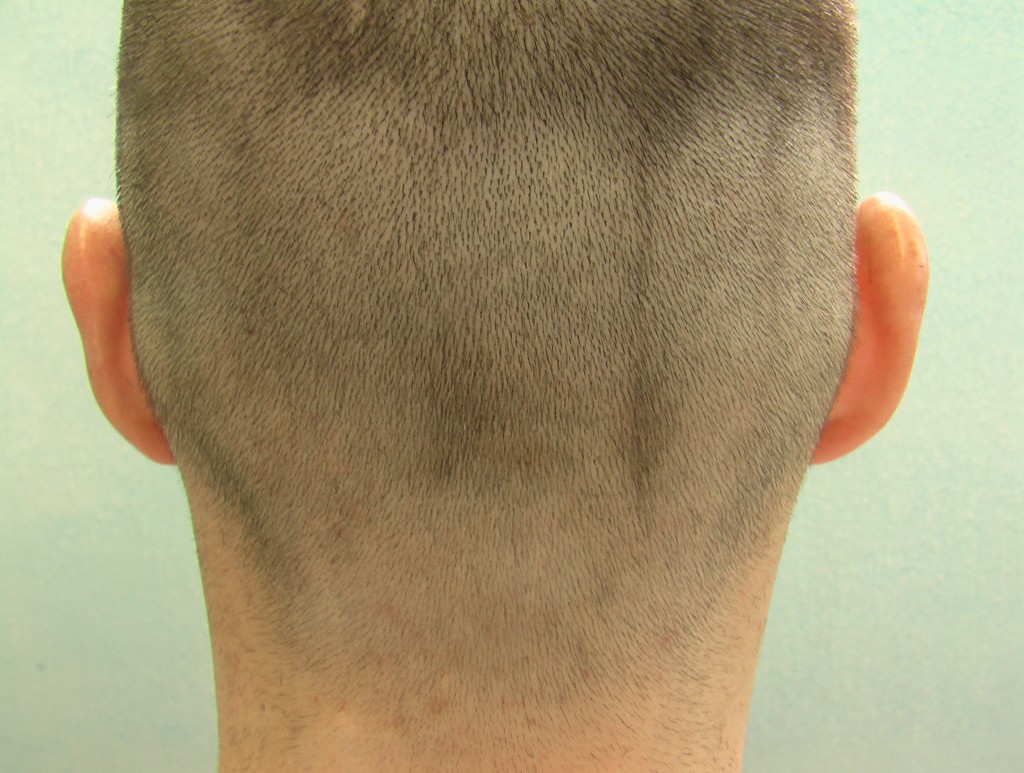 Positive FUE Shave Test