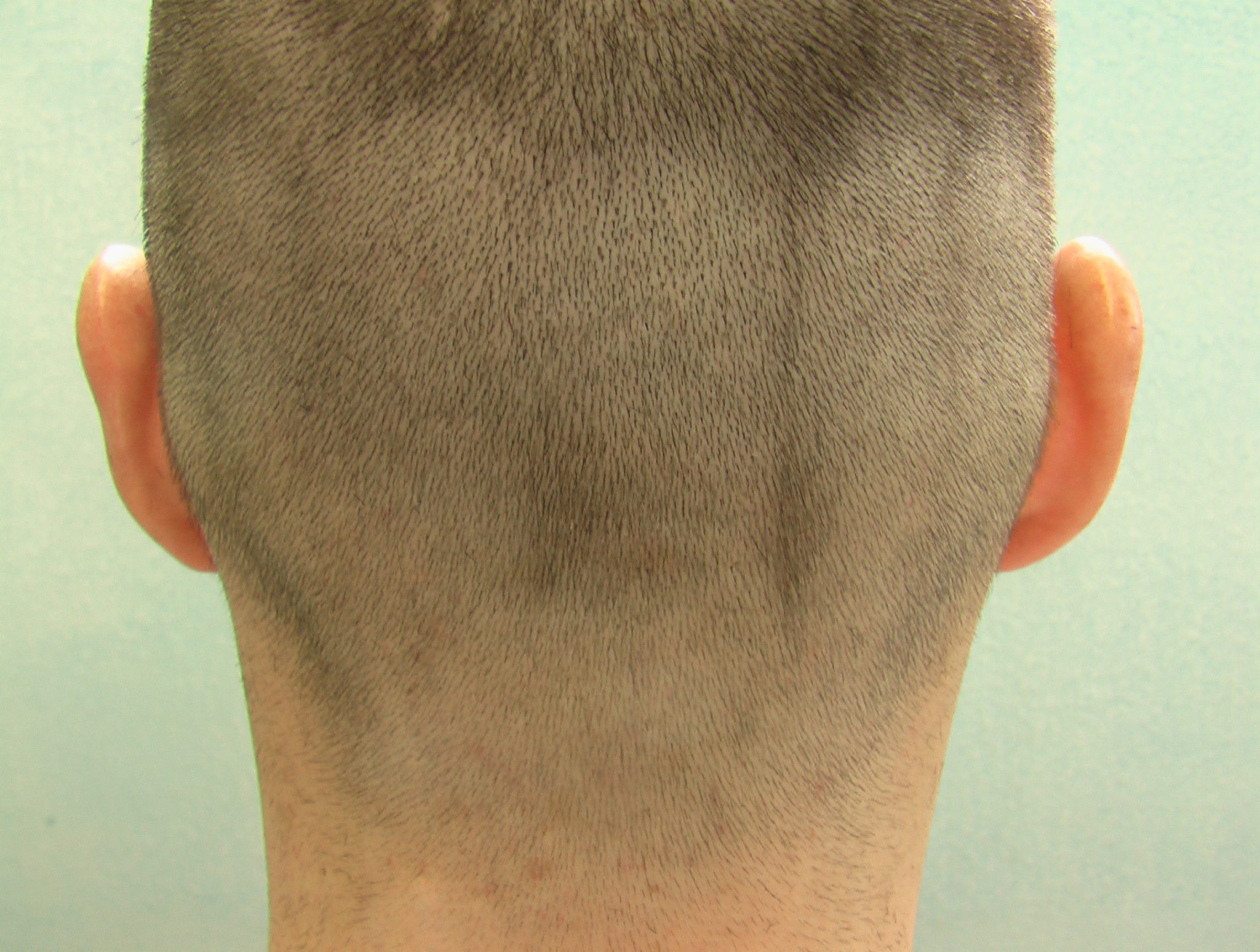 Follicular Unit Extraction Feasibility. Positive FUE Shave Test