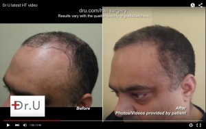 Before and after hairline restoration by Chest hair to head transplant