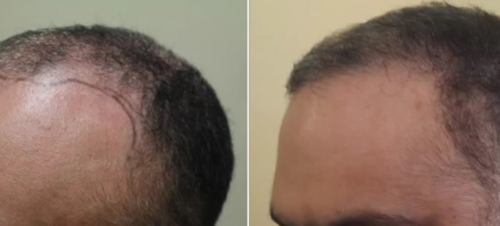 hair transplant procedures. platelet rich plasma can be an alternative for hair restoration. Before and after hairline restoration by chest hair transplants