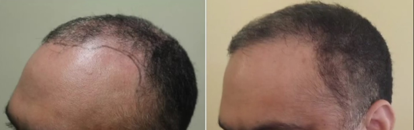 hair transplant procedures. platelet rich plasma can be an alternative for hair restoration. Before and after hairline restoration by chest hair transplants