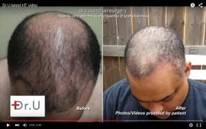 Results in the crown and hairline from head, beard and chest hair transplant