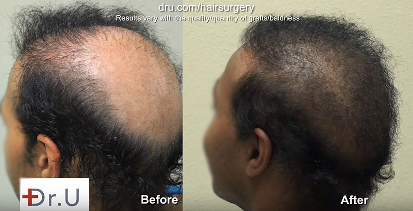 good hair loss concealer practices: patient opted for a combination of body hair transplant and SMP