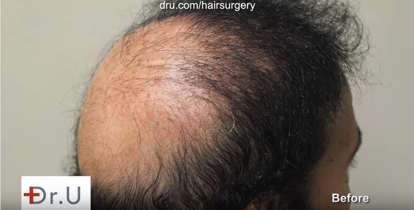 Severe baldness and donor depletion repaired using UGraft FUE and sacl pigmentation