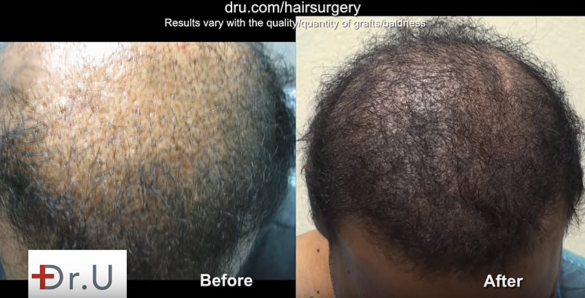 Body Hair Transplant Repair In African American before and after