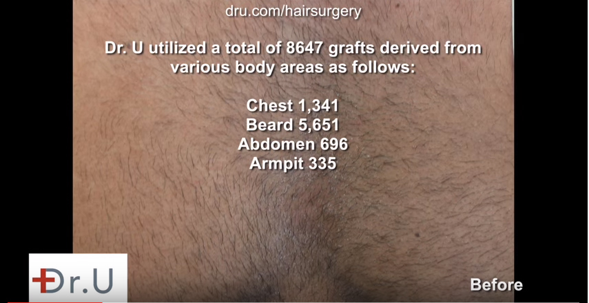 Transform severe baldness - Total grafts from successful BHT