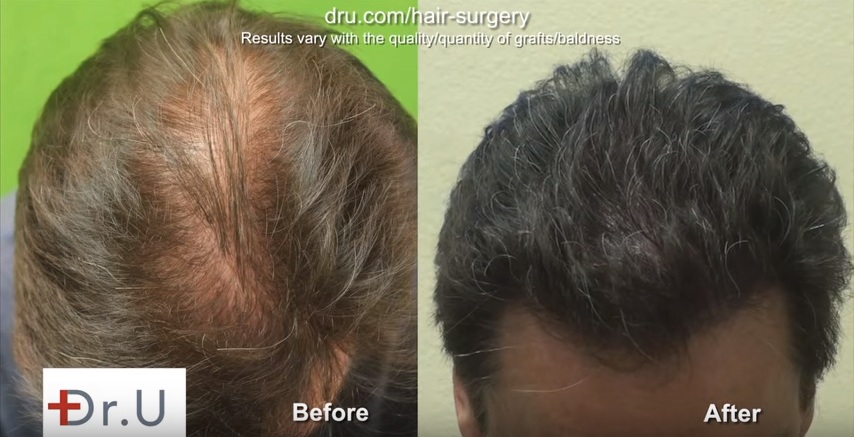 BHT result not affected by different hair textures due to proper planning by Dr U. Different Hair texture