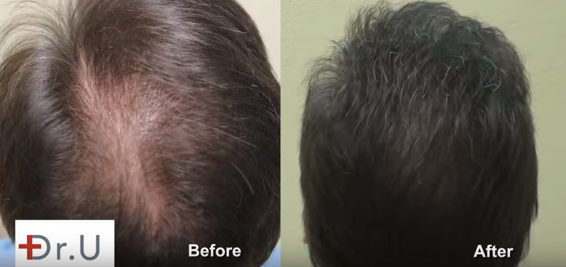 FUE Hairline Transplant and Increasing Density