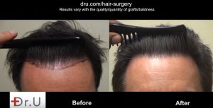 Natural looking hairline can be combed after UGraft FUE Hairline Transplant using nape hair