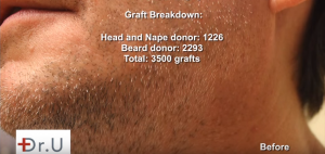 Total graft breakdown that Dr. U used for FUE Hairline Transplantation. Beard, Head, and Nape donor area yield a successful graft for the FUE Hairline Transplant.