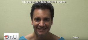 The happy patient is fully healed with a new hairline and hair density after a FUE Hairline Transplant.