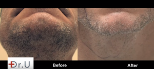 FUE Hairline Transplant successfully uses beard as hair donor. Beard hair transplant completely healed with minimal pain after FUE Hairline Transplant