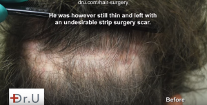 The surgery scar left by a previous hairline surgery was covered up by Dr. U