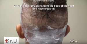 Nape area used to reconstruct hairline and temples