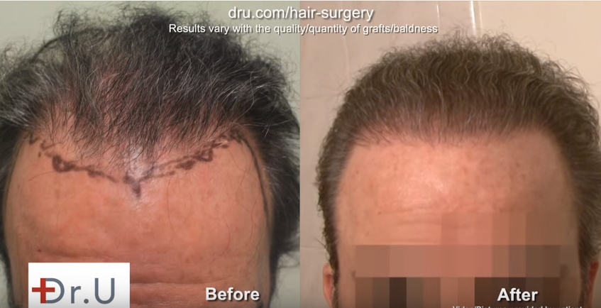 will transplanted hair follicles fall? nape hair donors