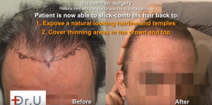 Undetectable hairline transplant before and after