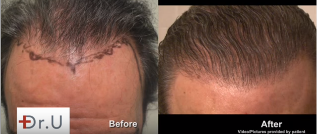 hairline refinement by UGraft Advanced FUE