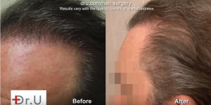 Before and after side view of patient's temples after UGraft surgery undetectable