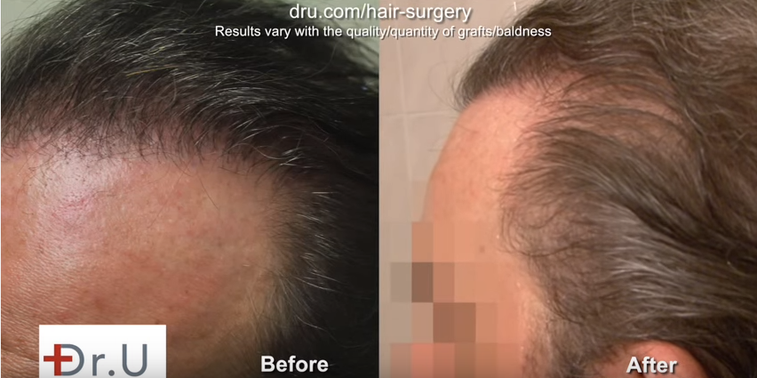 hair transplant cost reduction