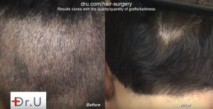 After a year of Face Framing using FUE hairline transplant patient has no significant scarring.