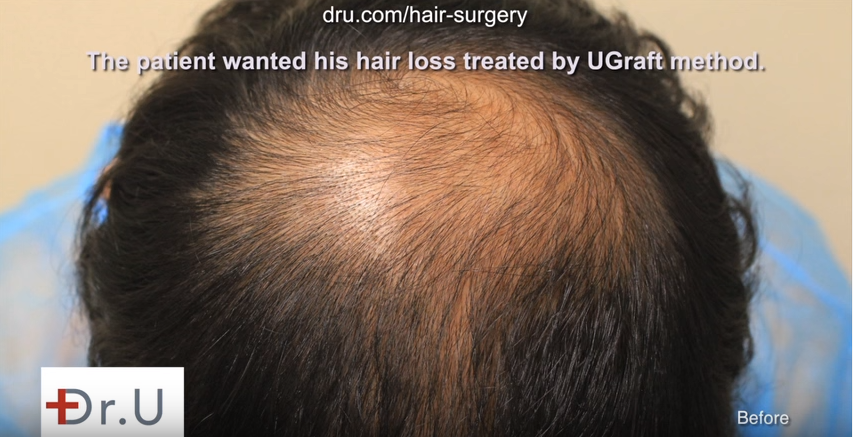 Face Framing using FUE hair transplant featured image