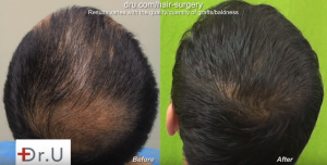 Face Framing using FUE hairline transplant, plus back of the head covered with natural looking hair after FUE surgery.