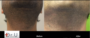 White dotting covered up using trichopigmentation in Face Framing using FUE hairline transplant