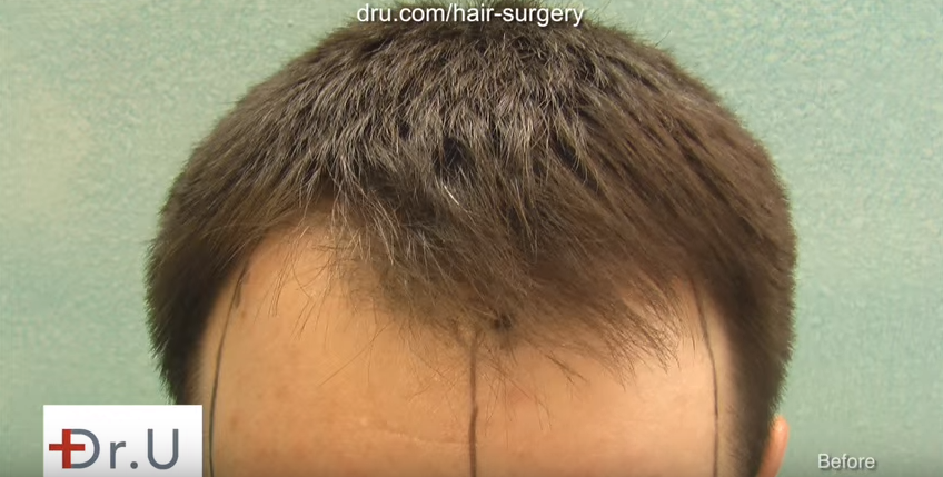 8 years before fue hair transplant