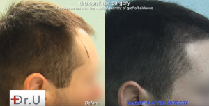 FUE Hair Transplants are forever? Patient needs follow up surgery 8 years later.