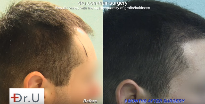 FUE Hair Transplants Are Forever? Well, so Is Progressive Hair Loss. -  DermHair Clinic