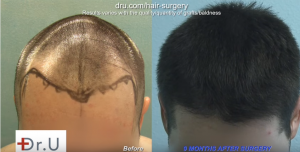 9 months after surgery, this patient thought FUE Hair Tranplants are forever.