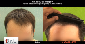 FUE Hair Transplants are forever? It is possible that the patient will needed further surgery later.