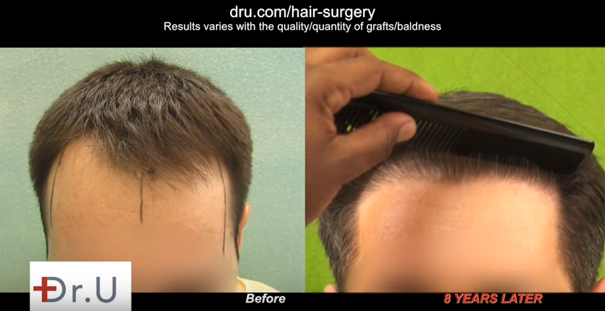  UGraft advanced FUE hair transplantation using nape grafts for the creation of an aggressive but soft and natural looking hairline in a younger patient