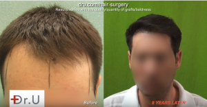 One may think FUE Hairline Transplants are forever, but further surgery may be needed.