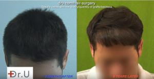 8 years later patient needs additional surgery debunking the myth that FUE Hair Transplants are forever.