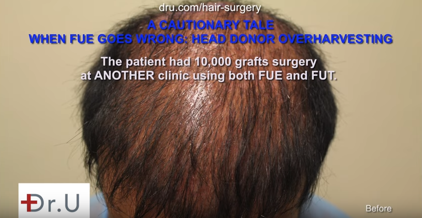 The results of bad FUE hair transplant planning after 10,000 grafts surgery at another clinic