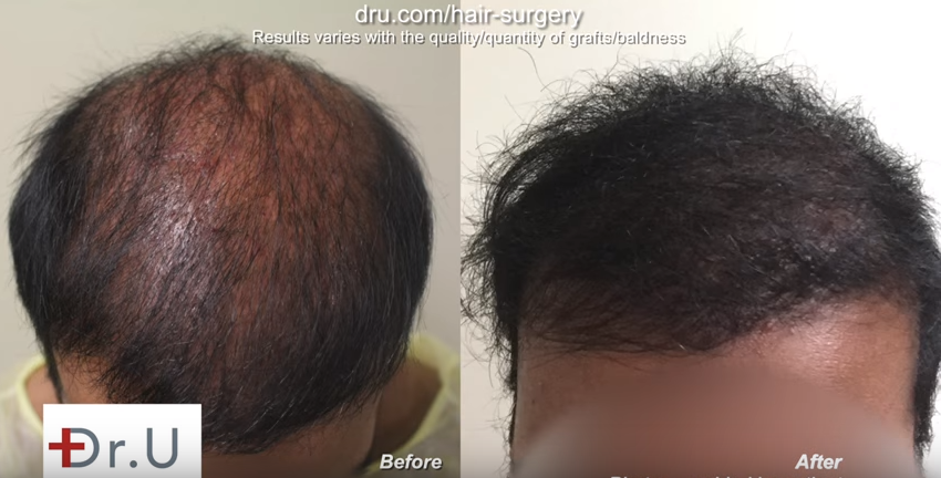 Bad FUE hair transplant planning corrected by Dr. U