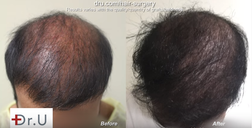 Bad fue hair transplant planning repair results Crown and overall density improved by Dr. U at just 5 months