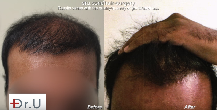 Corrected bad FUE hair transplant planning by Dr. U