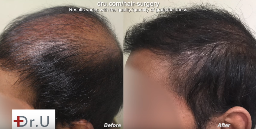 Temple and hairline improved by Dr. U, before and after bad fue hair transplant planning repair