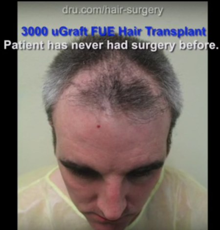 Hair loss patient receives 3,000 UGraft transplant for fuller coverage