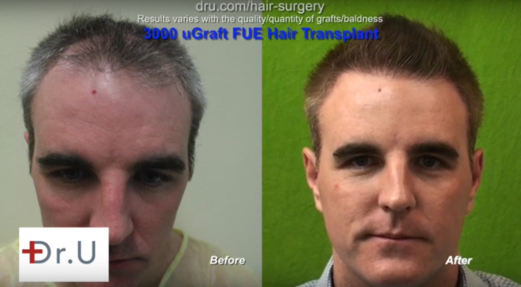 UGraft FUE hair transplant using UGraft in Los Angeles, frontal view before and after Los Angeles FUE Hair Transplant Surgery Using the UGraft, frontal view before and after