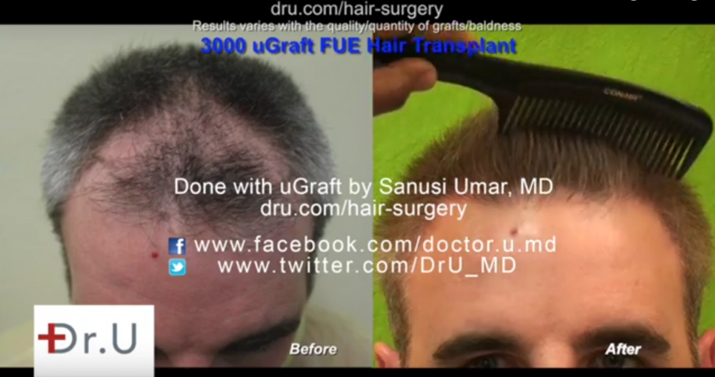 patient showing a very natural looking hairline following his UGraft fue hair restoration using only head hair