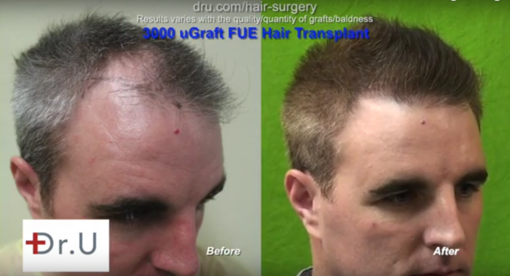 Hairline Restoration and Male Attractiveness. Dr U Patient before and after