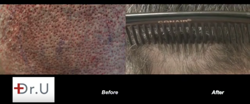 UGraft FUE hair transplant using UGraft in Los Angeles. Extraction wounds before and after