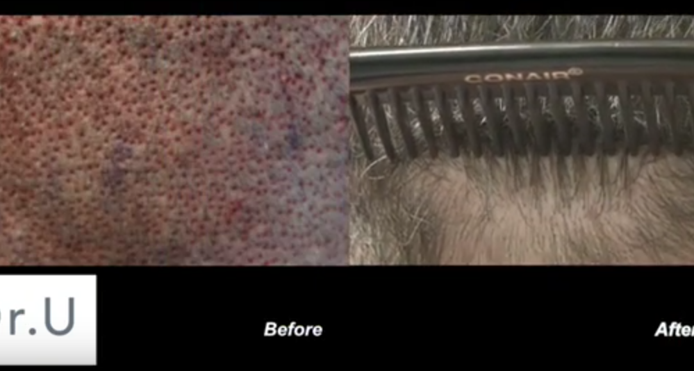 UGraft FUE hair transplant wounds before and after